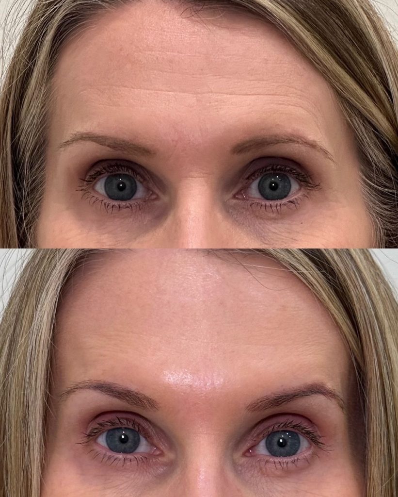 Brow Lift me toksinë botulinike Toksinë botulinike për vetullat