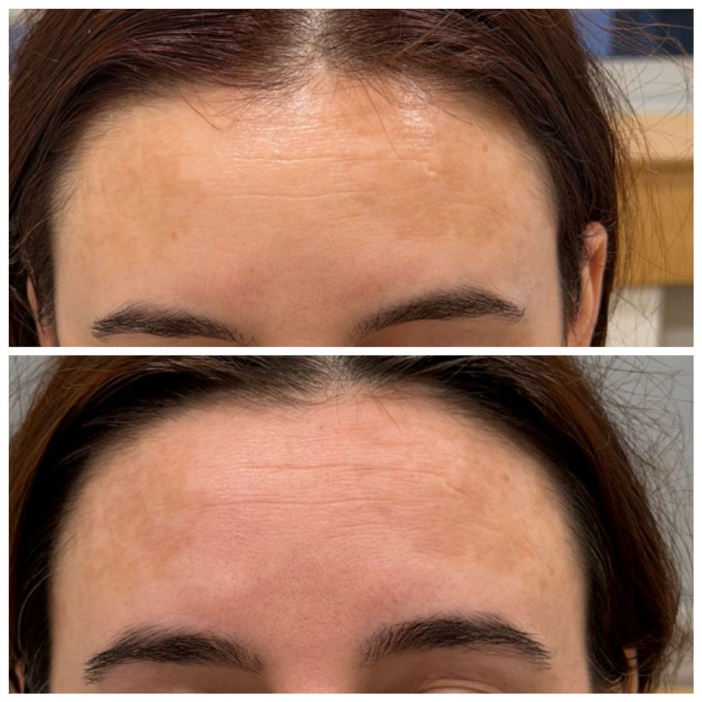 Eliminimi i Hiperpigmentimeve me Laser PicoSure Pro