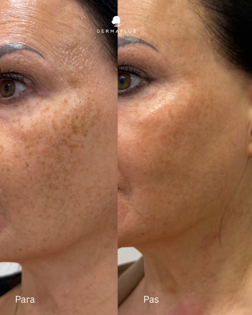 Eliminimi i Hiperpigmentimeve me Laser PicoSure Pro