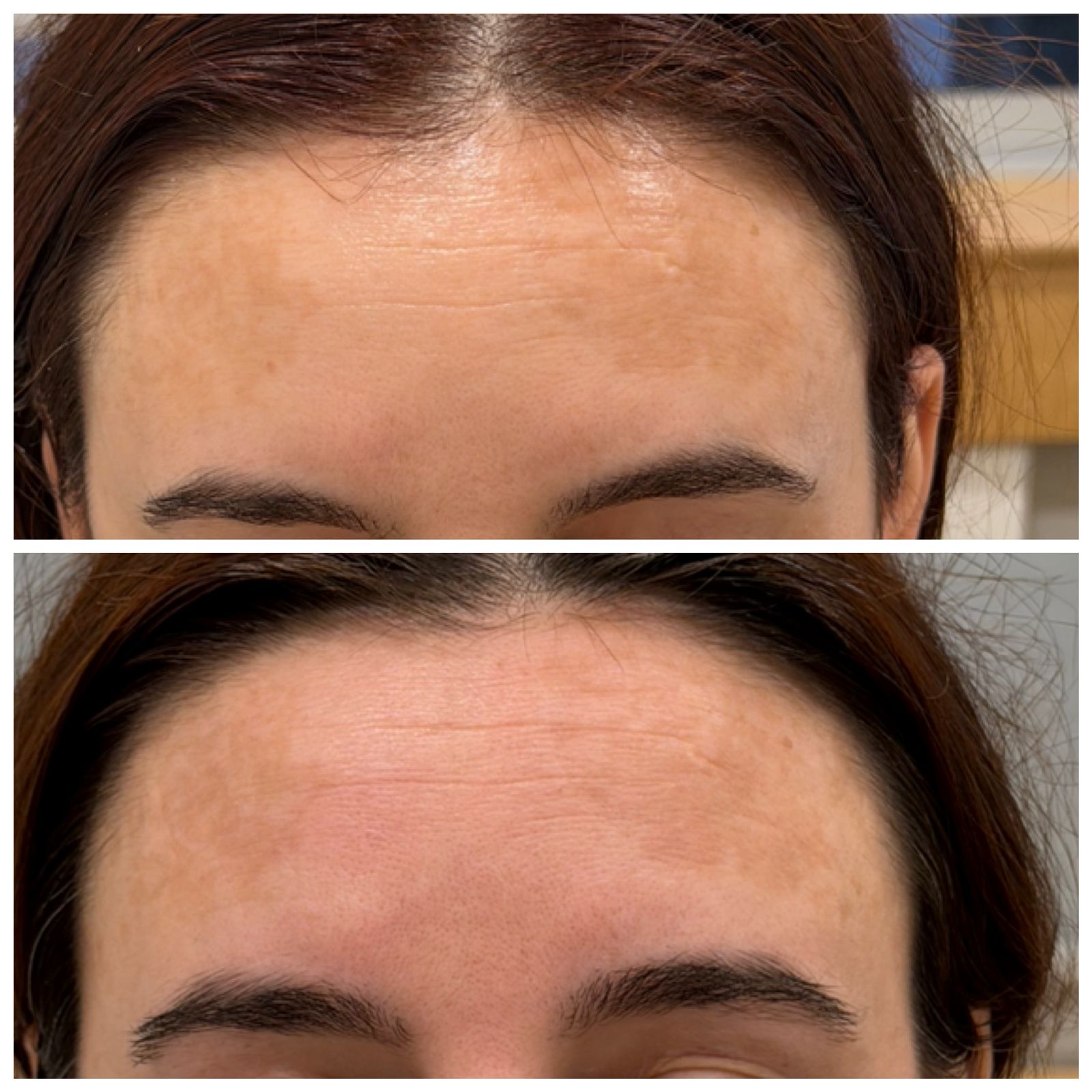 Eliminimi i Hiperpigmentimeve me Laser PicoSure Pro