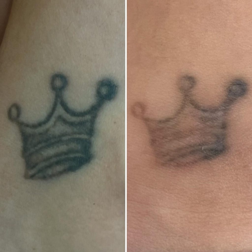 Eliminimi i Tatuazheve të Vetullave dhe Tatuazheve në Trup me PicoSure Pro