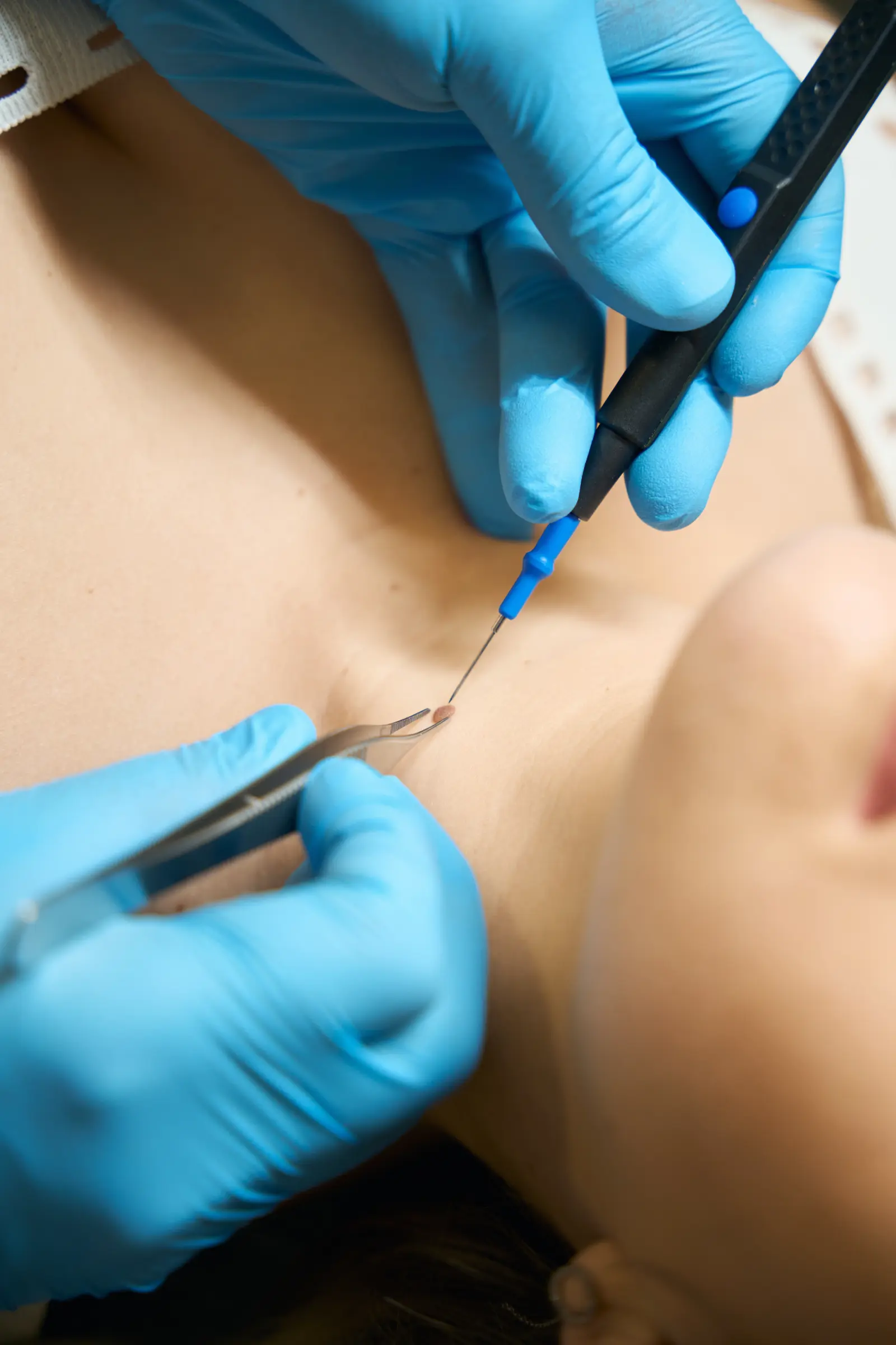 Heqja e Skin Tags (Fibromave të Buta) me Laser
