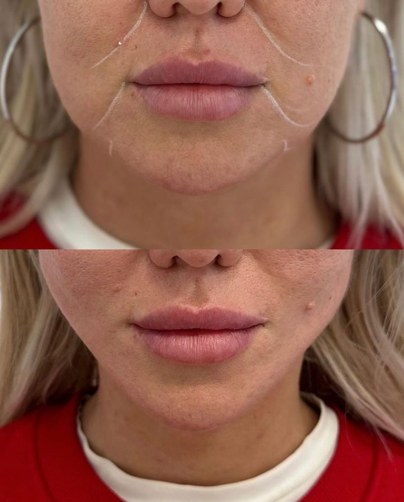 Konturimi i nofullës me Botox Masseter Botox