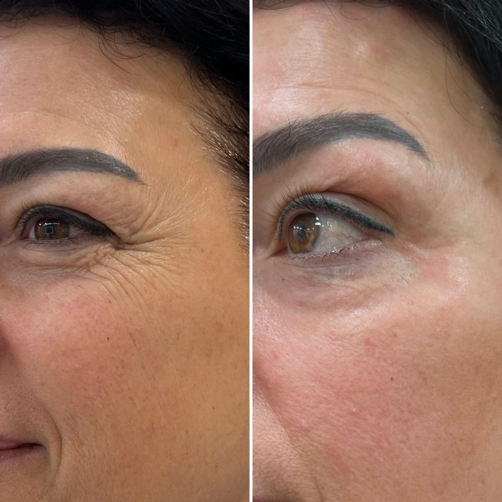 Trajtimi Potenza RF Microneedling