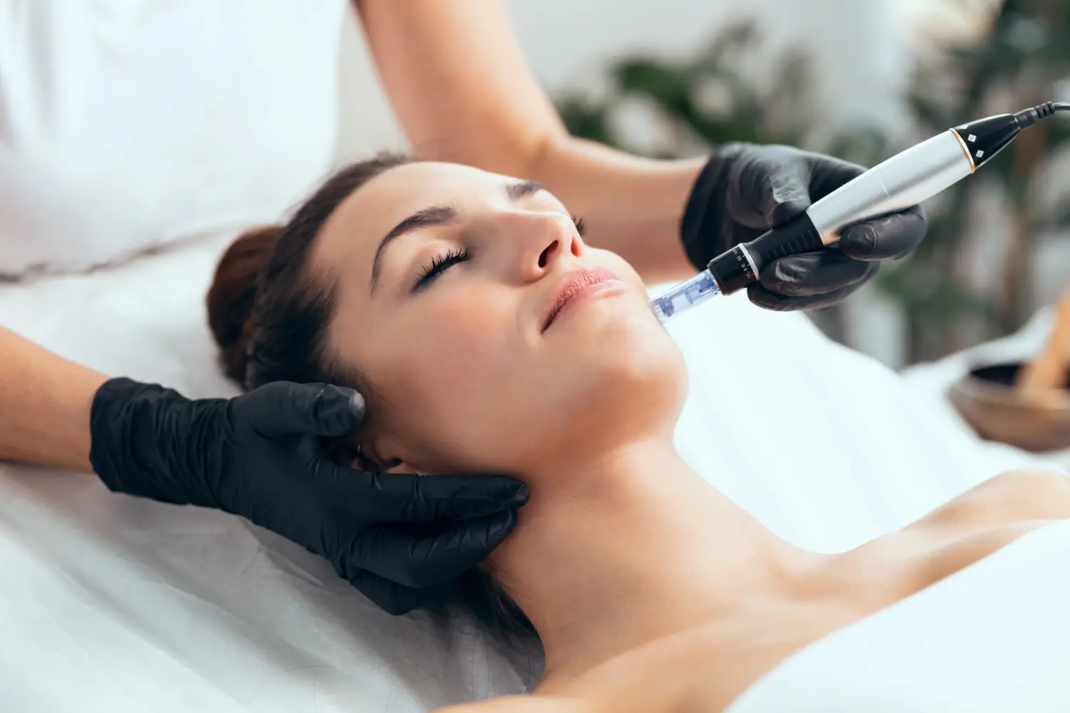 Trajtimi Potenza RF Microneedling
