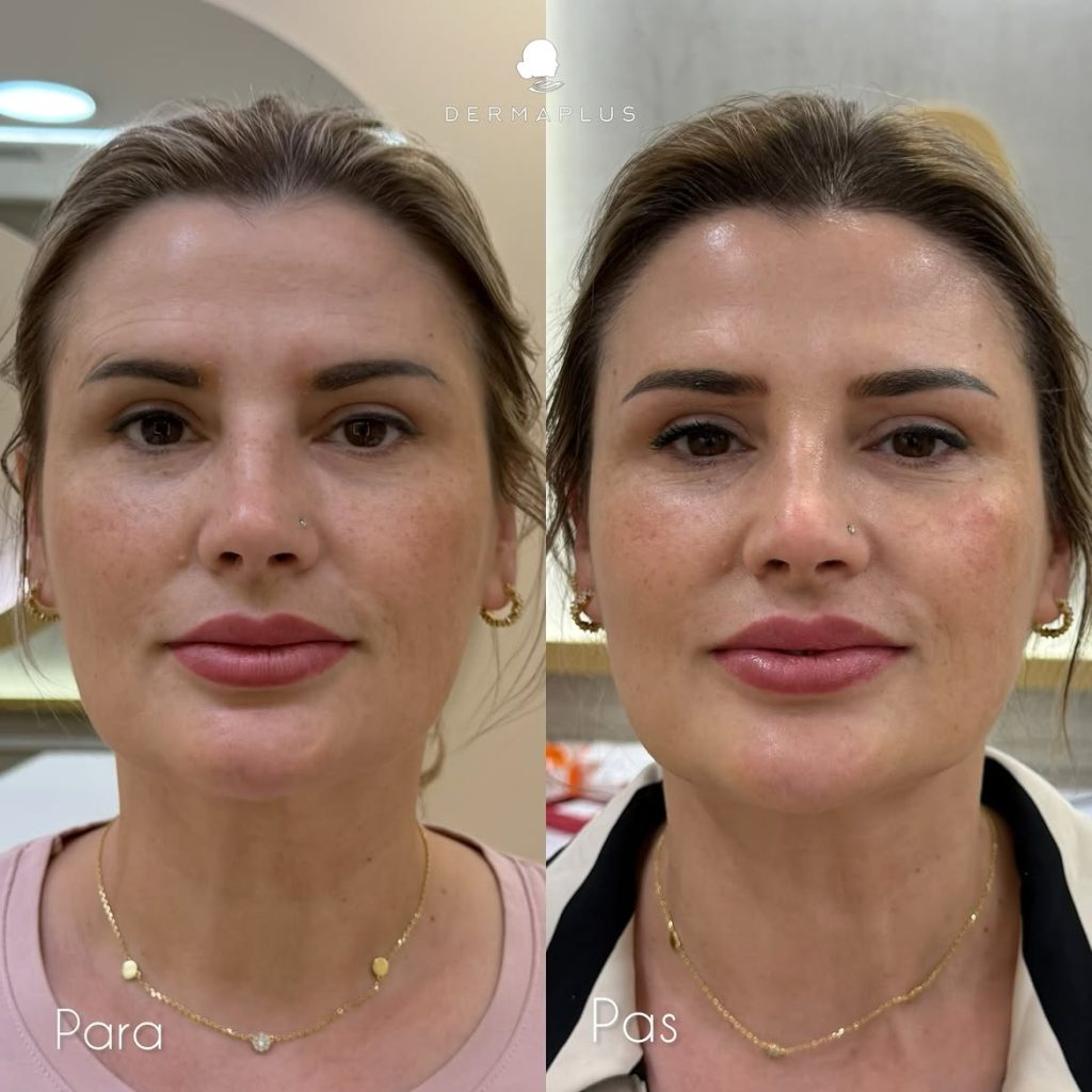 Trajtimi Sculptra
