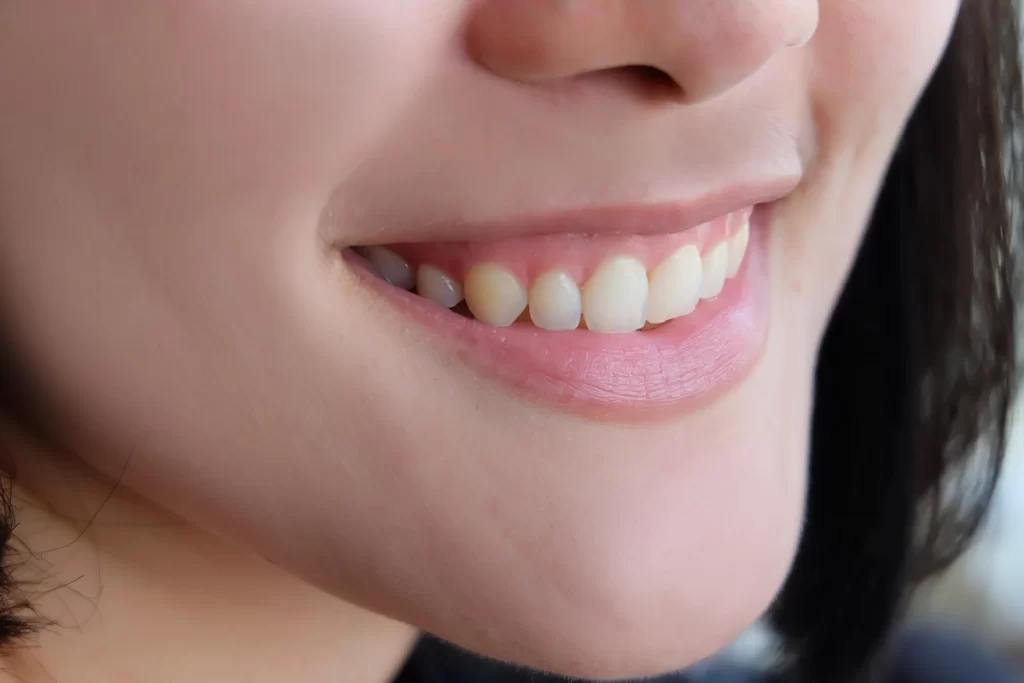 Trajtimi i Gummy Smile me Toksinë Botulinike