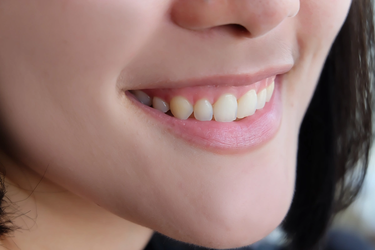 Trajtimi i Gummy Smile me Toksinë Botulinike