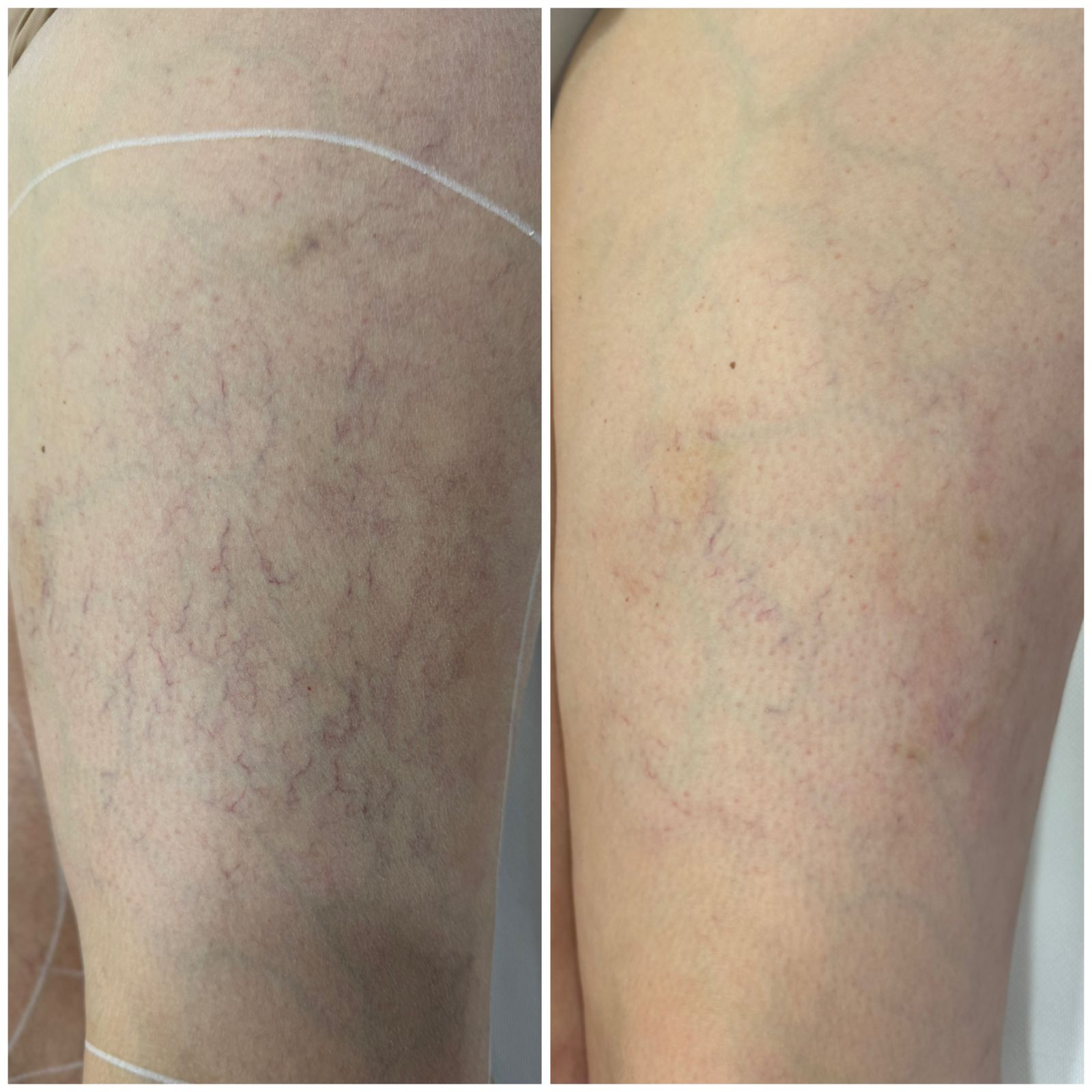 Trajtimi i Kapilarëve