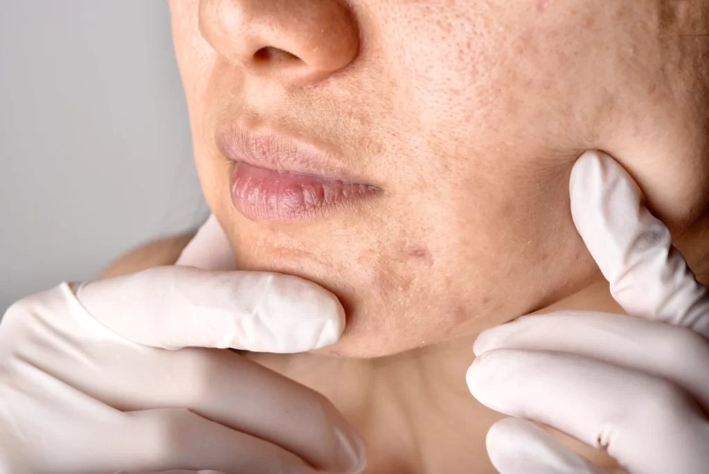 Trajtimi i Pigmentimit Post-Inflamator