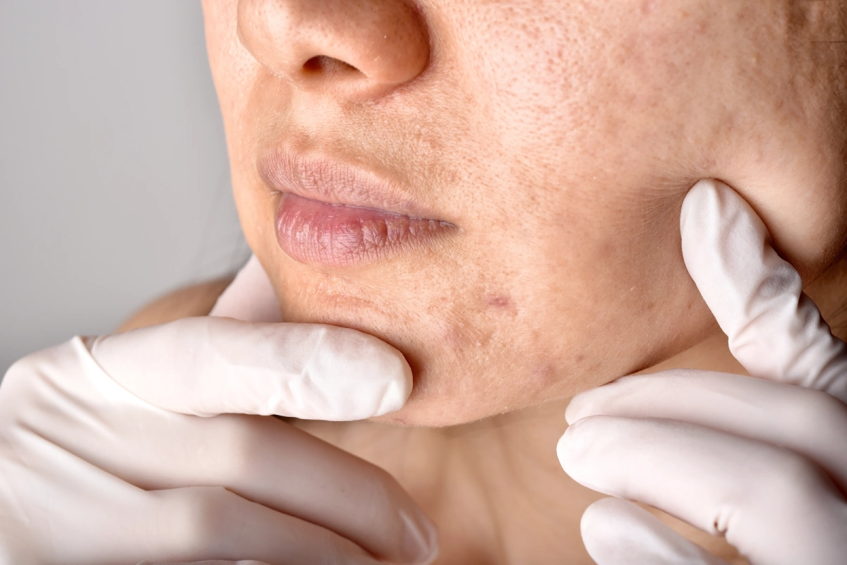 Trajtimi i Pigmentimit Post-Inflamator