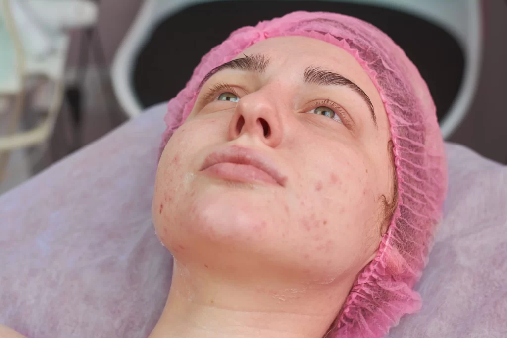Trajtimi i Shenjave të Akneve me Dermapen 4, Peeling dhe Maska
