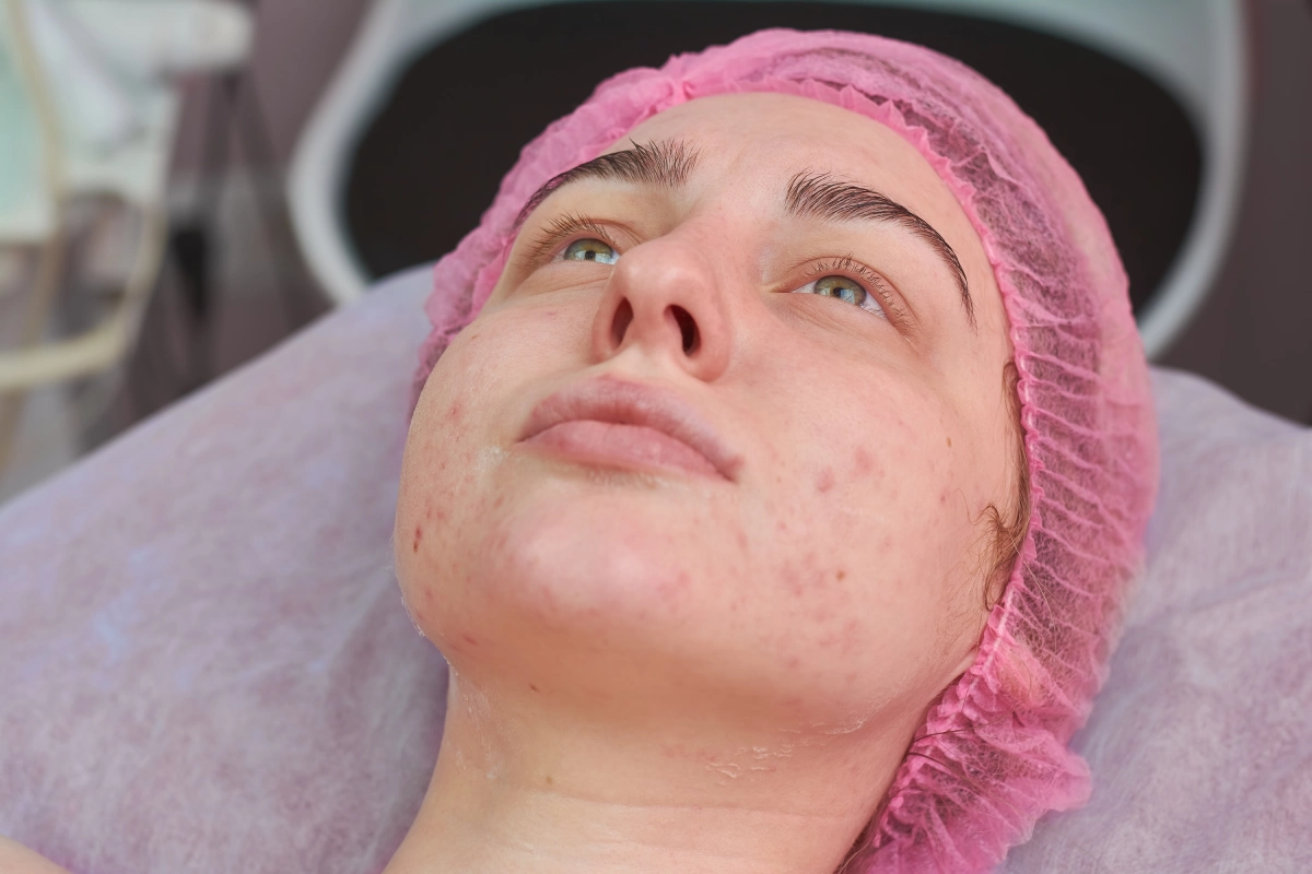 Trajtimi i Shenjave të Akneve me Dermapen 4, Peeling dhe Maska